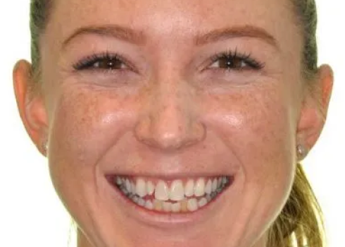 Case becca before query